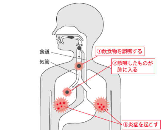 誤嚥性肺炎とは バランス株式会社